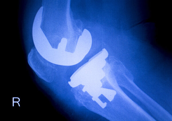 Knee orthopedic implant xray scan Medical Device Litigation